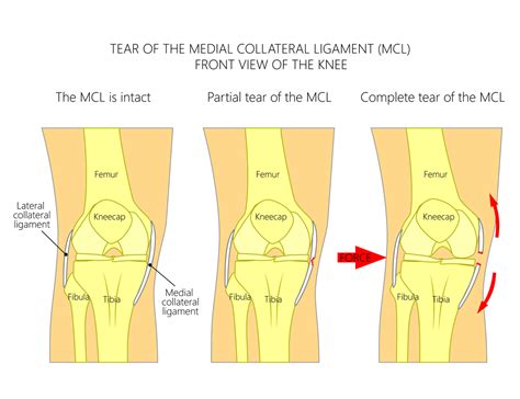 acl mcl tear test|worst NBA injuries acl mcl.